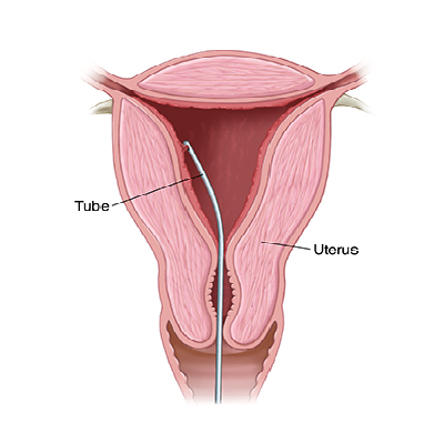 ERA Medical Illustration