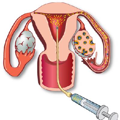 IUI Medical Illustration